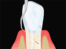 periodontiki therapia